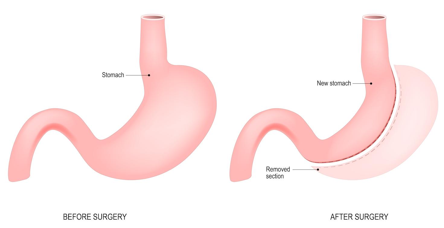 best gastric sleeve surgeon Melbourne